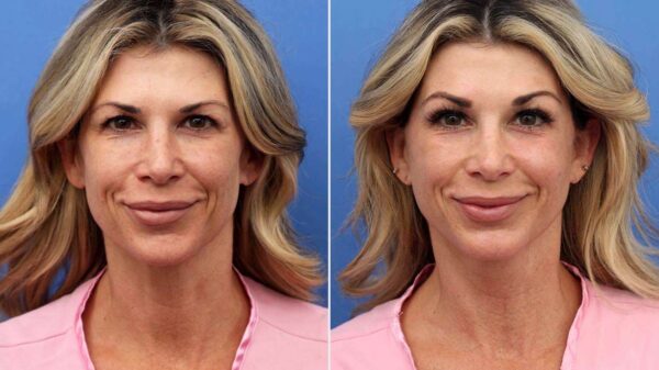 “Real Housewives” Star Alexis Bellino Is Already Celebrating Her 50th Birthday. She Bought Herself a Facelift (Exclusive)