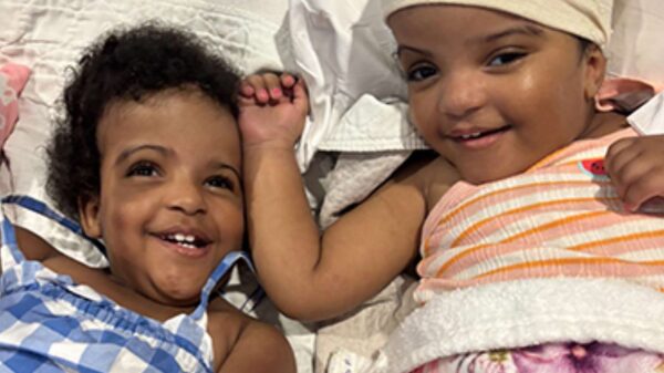 Twins Conjoined at the Head Underwent Successful Separation Surgery That Took More Than 24 Hours