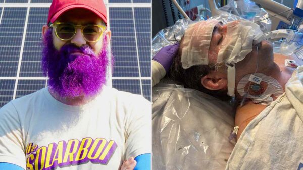 Man Left with Severe Burns from Electrical Explosion Says He Never Expected Losing His Fingerprints to Be So ‘Emotional’ (Exclusive)