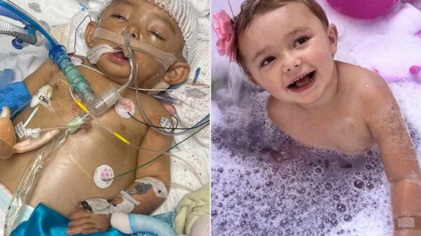 Girl Survived 25 Surgeries, a Liver Transplant and the Loss of 5 Fingers All Before Turning the Age of 3 (Exclusive)
