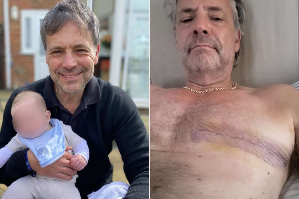 Man, 63, Said His Doctors Told Him Pea-Sized Lump on His Chest Was ‘Probably Nothing.’ It Turned Out to Be Breast Cancer