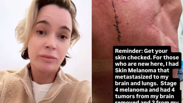 Teddi Mellencamp Shares Reminder to ‘Get Your Skin Checked’ on Immunotherapy Day for Stage 4 Cancer