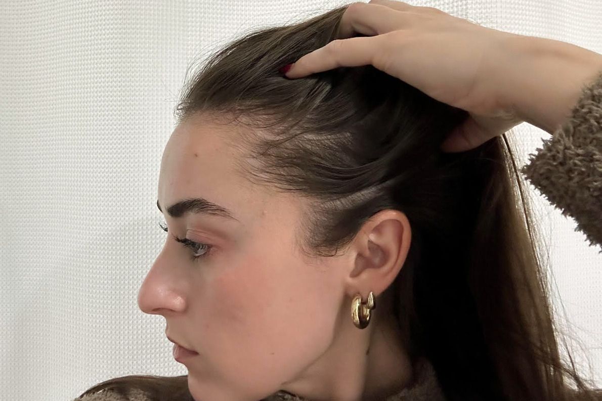 A person before using Advanced Trichology NutraM Topical Melatonin Hair Growth Serum