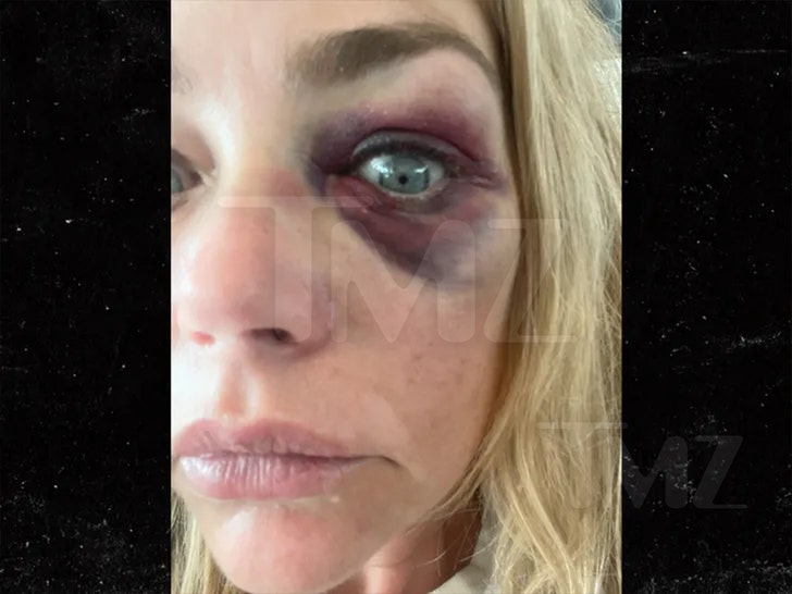 denise ricahrds and Aaron Phypers alleged injuries lawsuit 7