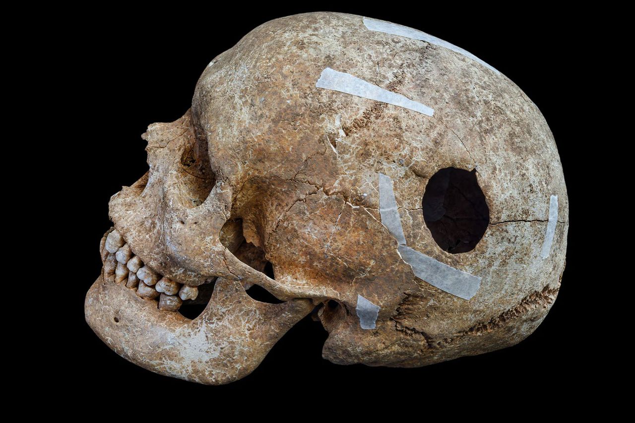 University Students Make ‘Extraordinary Discovery’ of Viking-Era ‘Execution Pit’ During Archaeological Training Dig A skull with a large hole discovered by University of Cambridge archaeologists and studentsCredit: Cambridge Archaeological