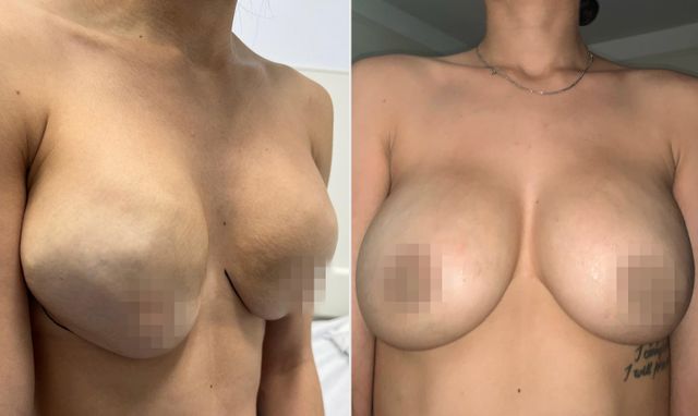 Evelyn's breasts after her original augmentation (left); Evelyn's breasts after Dr. Fisher's work (right)Credit: Evelyn M. Feliciano/Dr. Fisher