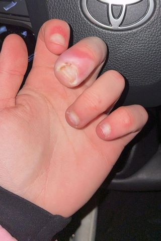 Gabby Swierzewski's finger.Credit: Gabby Swierzewski