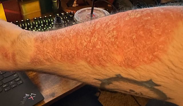 Maddox Patt's plaque psoriasis.Credit: Courtesy of Maddox Patt
