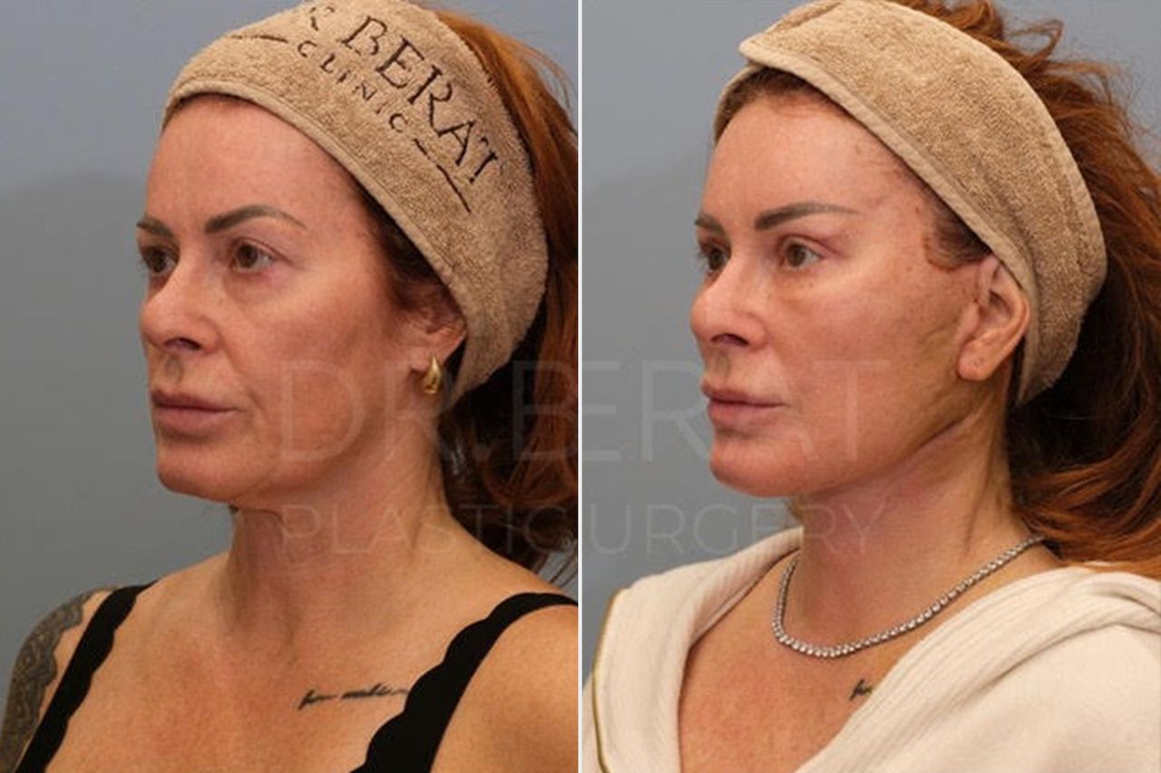 Before-and-after photos of Star Monroe's plastic surgeryCredit: Dr. Berat Cigdem