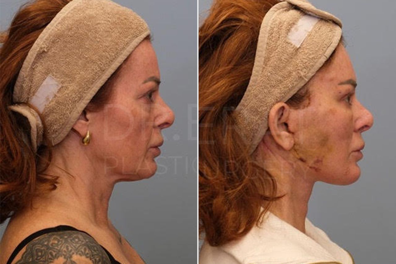 A side profile of Star Monroe's cosmetic enhancementCredit: Dr. Berat Cigdem