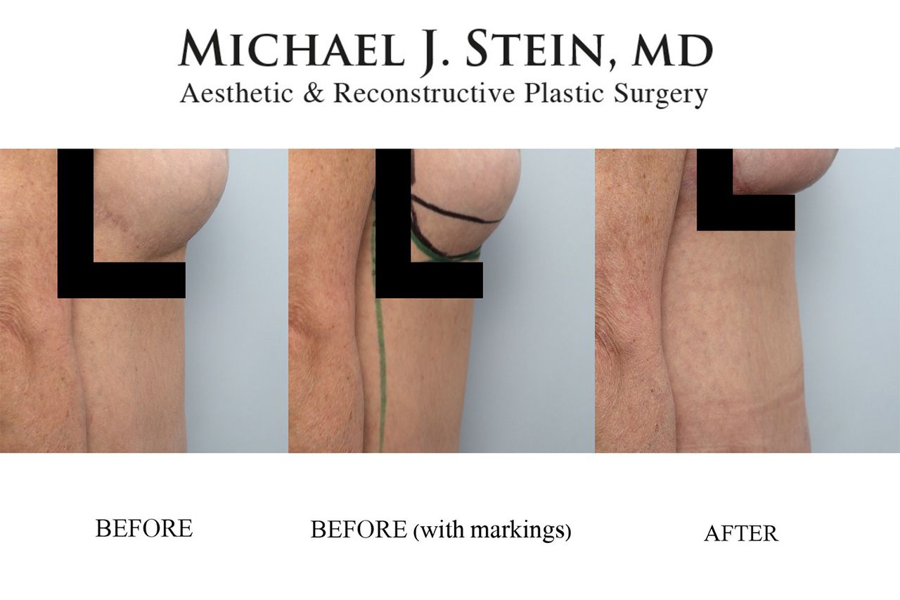 Jennifer Fessler before and after her most recent breast surgeryCredit: Dr. Michael Stein