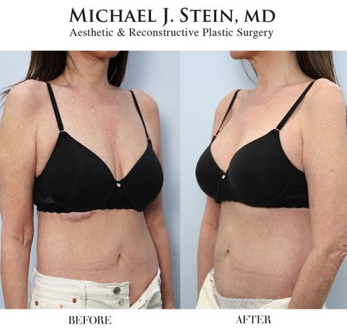 Jennifer Fessler before and after her fifth surgeryCredit: Dr. Michael Stein