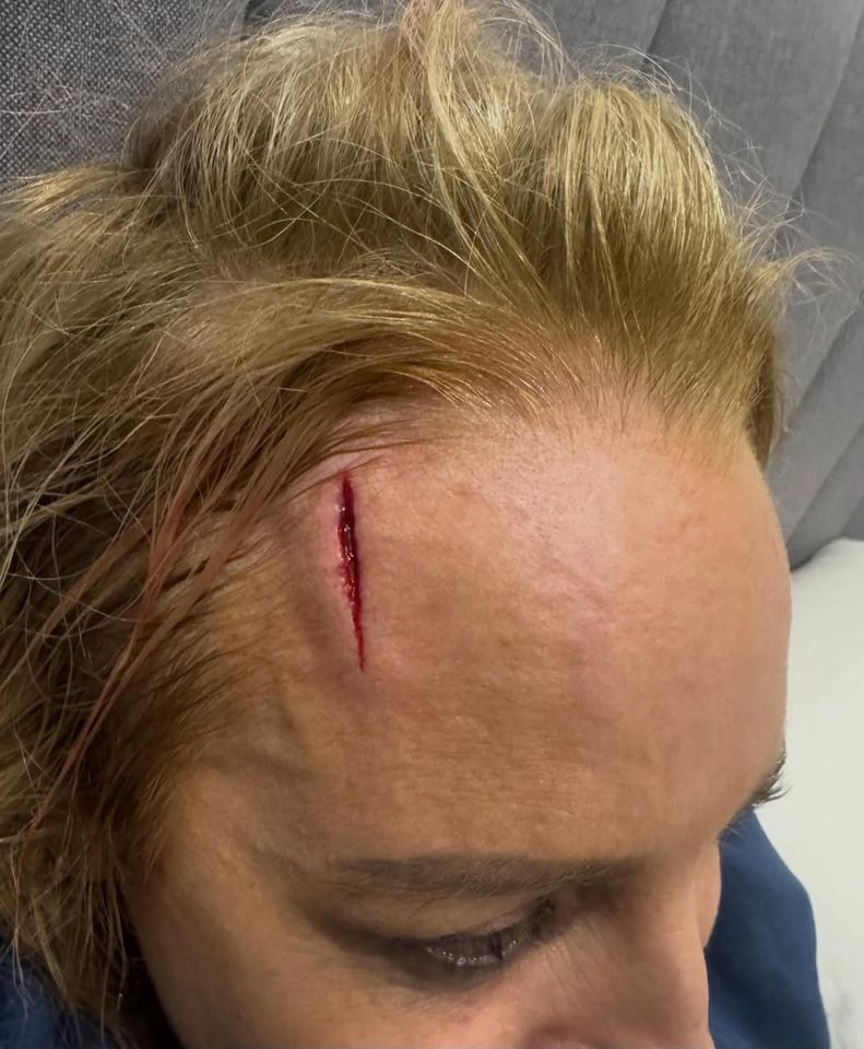 Carrie Bickmore shows off her severe head injury on Instagram.Credit: Carrie Bickmore/Instagram