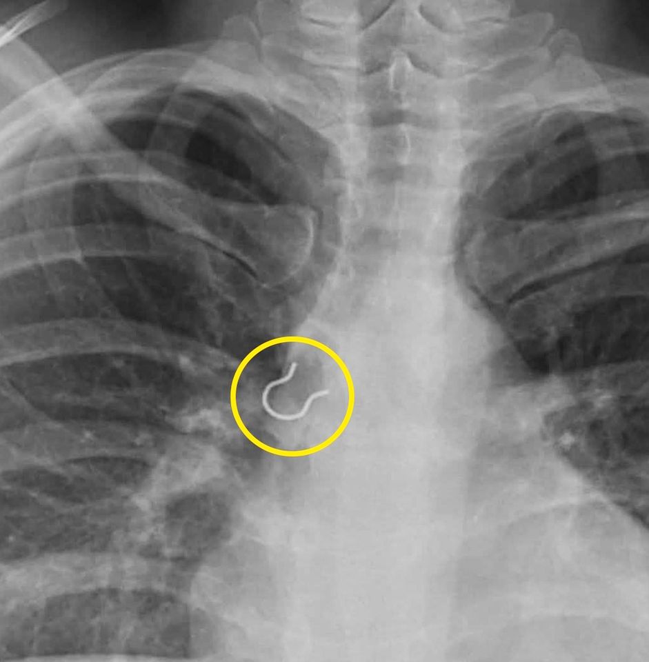 Shelby Willis' chest X-rayCredit: Kennedy News & Media
