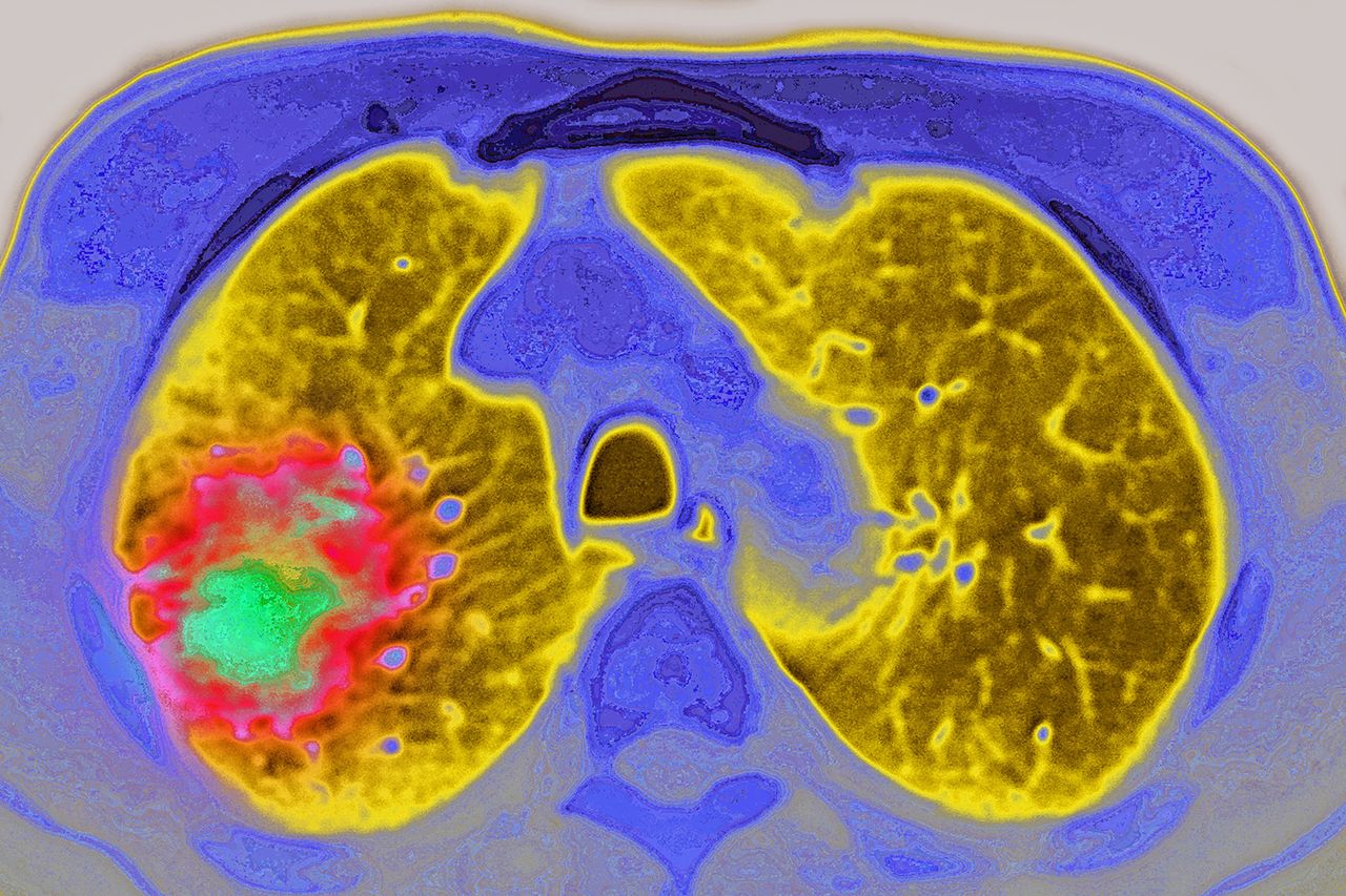 Stock image of lung cancer seen on a chest MRI scanCredit: Cavallini James/BSIP/Universal Images Group via Getty