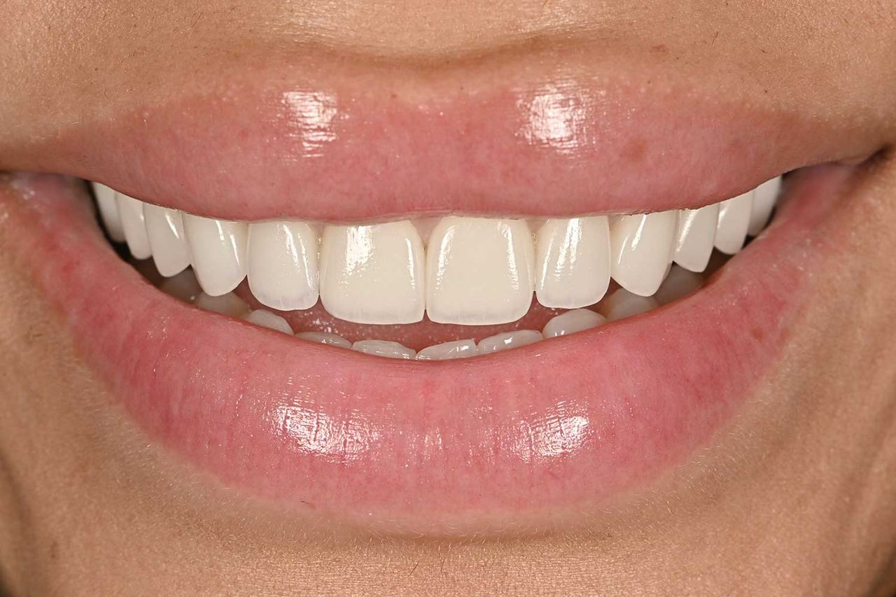 Amaya Espinal teeth Amaya Espinal's teeth after.Credit: Courtesy of Dr. Nick Mavro