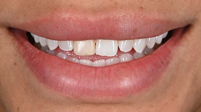 Amaya Espinal teeth Amaya Espinal's teeth before.Credit: Courtesy of Dr. Nick Mavro