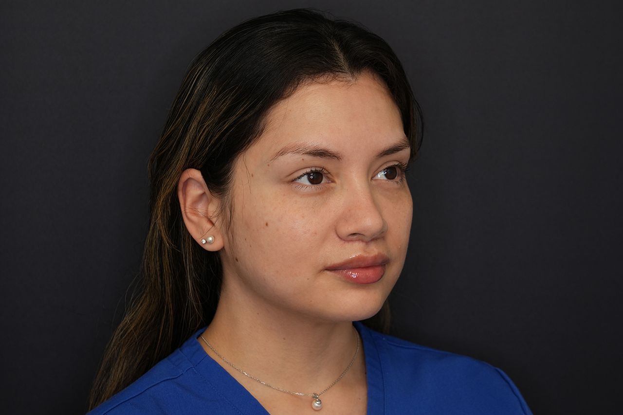 Karen after lip liftCredit: Z Face Plastic Surgery