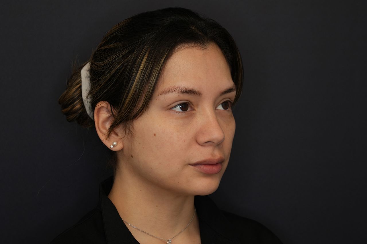Karen before her lip liftCredit: Z Face Plastic Surgery