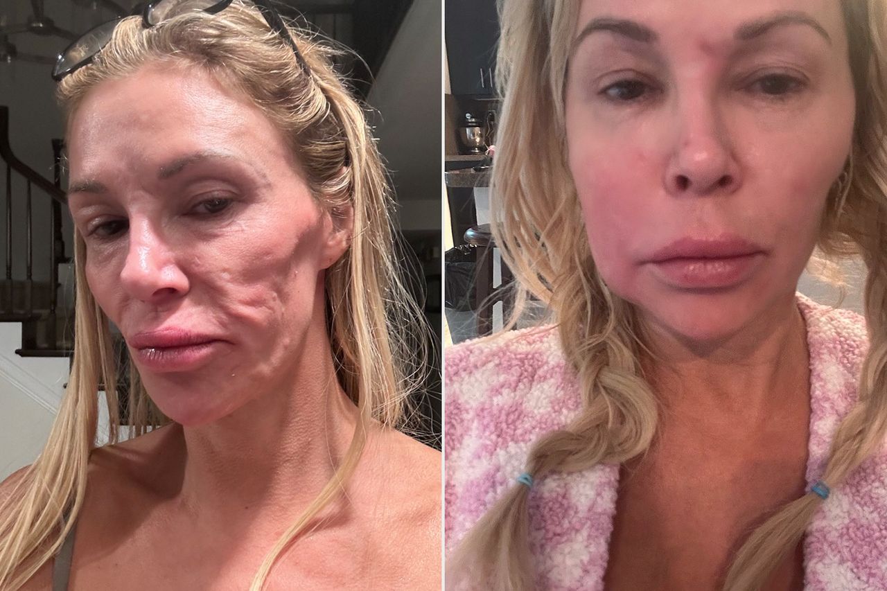 Brandi Glanville showing off her facial disfigurementCredit: BrandiGlanville/X; Brandi Glanville/Instagram