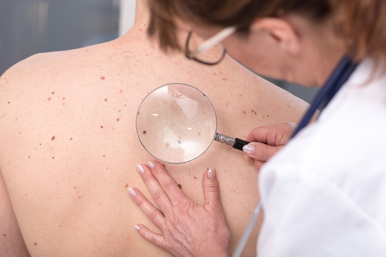 Stock photo of a mole checkCredit: Getty