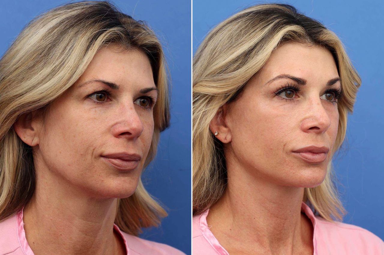 The results of Alexis Bellino’s cosmetic surgeryCredit: Dr. John Layke