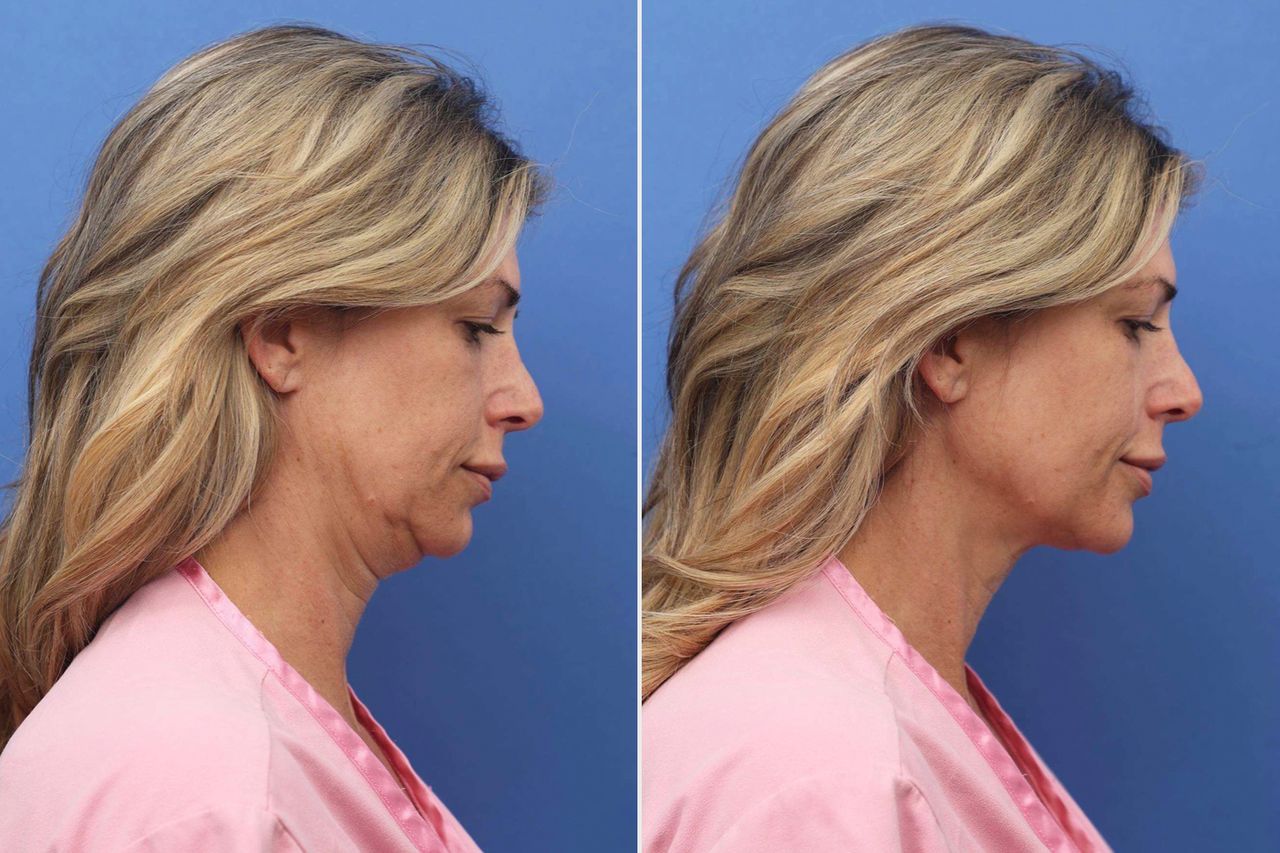 Alexis Bellino before and after her face and neck liftCredit: Dr. John Layke