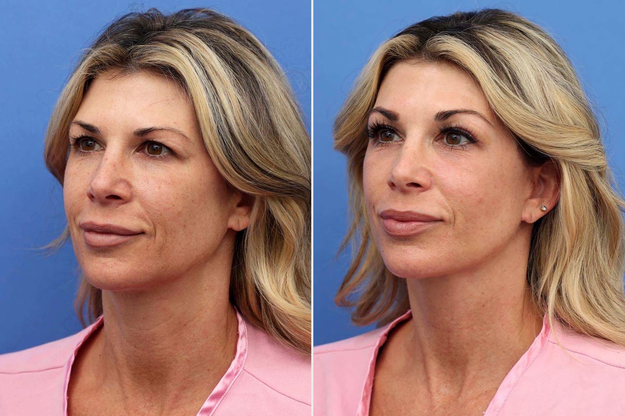 Alexis Bellino before and after surgery performed by Dr. John LaykeCredit: Dr. John Layke