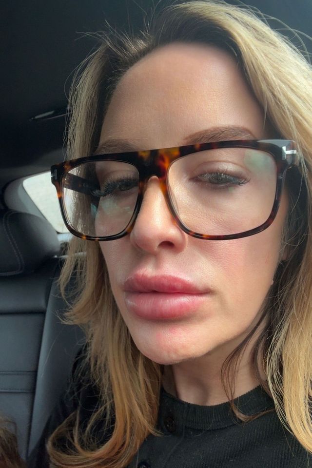 DANIELLE BRYCE Mom Danielle Bryce said she was “obsessed” with lip fillers.Credit: Kennedy News/daniellebrycey