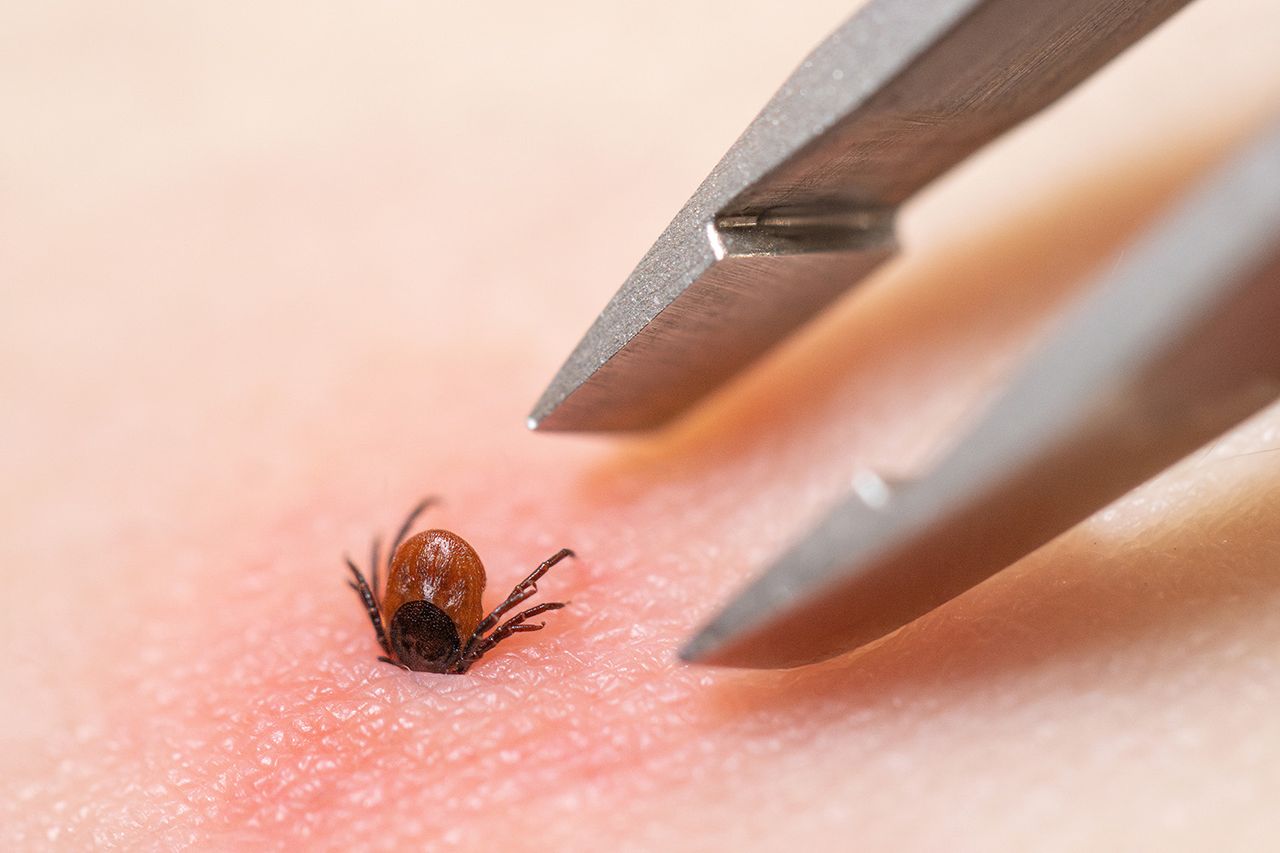 Tweezers next to a tick embedded in human skin (stock photo)Credit: Getty