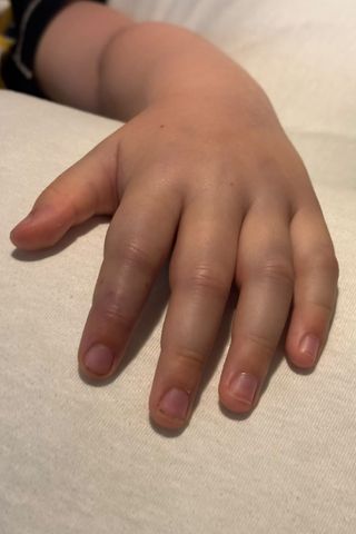 Kenzie Macrae’s swollen handCredit: Kennedy News and Media